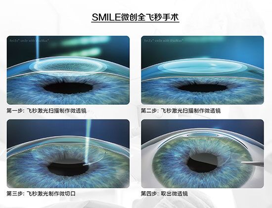 蔡司全飛秒、蔡司半飛秒近視手術(shù)與宇航飛秒的區(qū)別