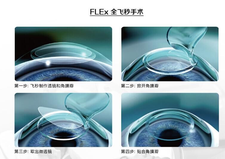 蔡司全飛秒、蔡司半飛秒近視手術(shù)與宇航飛秒的區(qū)別