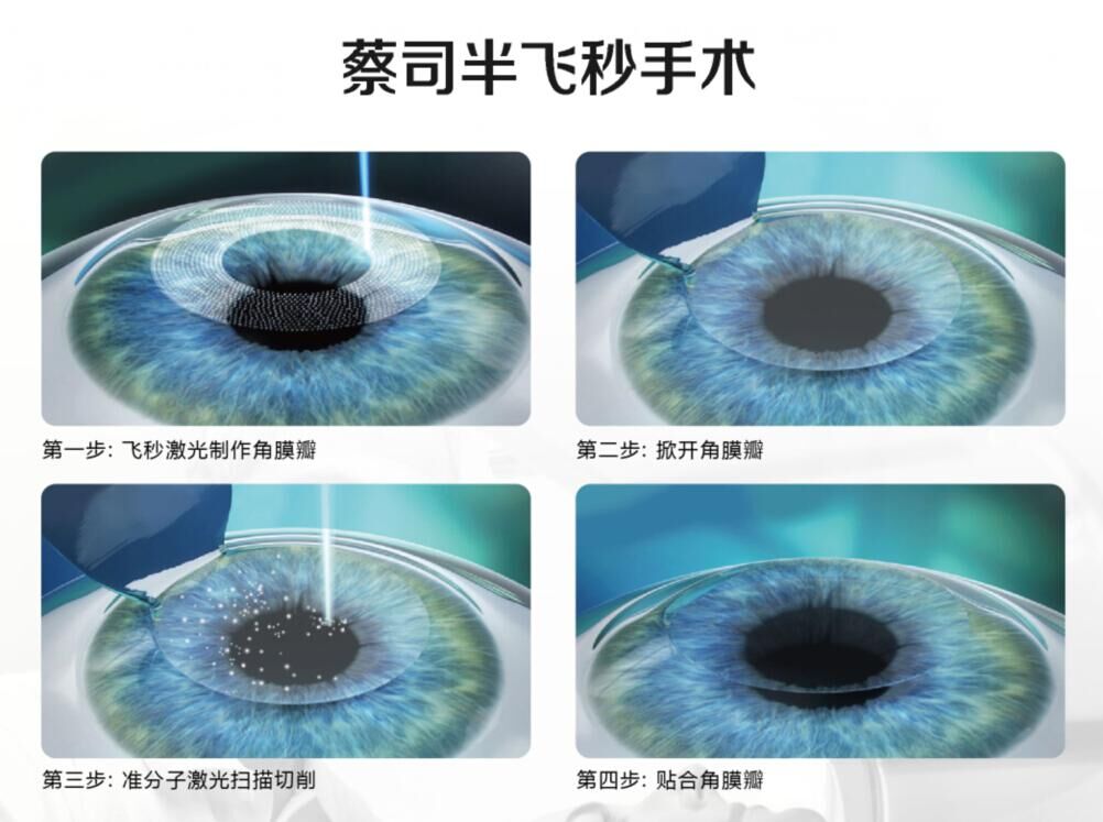 蔡司全飛秒、蔡司半飛秒近視手術(shù)與宇航飛秒的區(qū)別